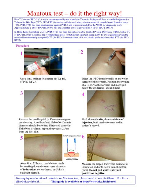 Mantoux Test: Uses, Procedure and Test Results .